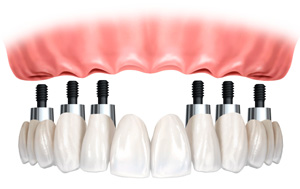 Fixed bridge implant