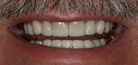 Case Two After Prosthodontics