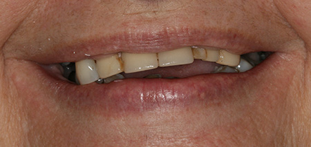 Case One before rehabilitation