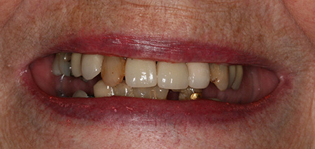 Case two before rehabilitation
