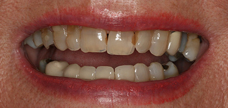 Case Three before smile enhancement