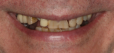 Case three before rehabilitation