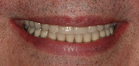 Case three after rehabilitation