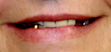 Case four before rehabilitation