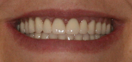 Case four after rehabilitation